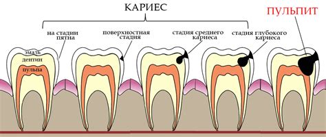 Лечение кариеса в городе Раменское цена от 1600 руб - «New Smile»