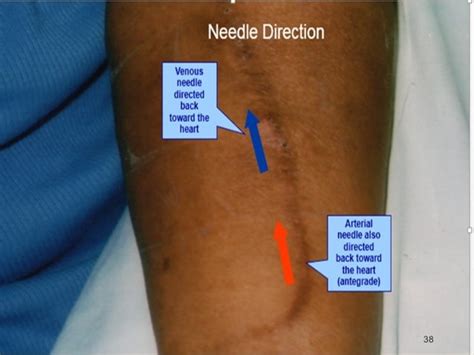 Fistula (Arteriovenous fistula -AVF)