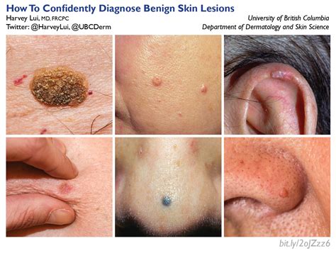overview  benign skin lesions common lesions  management ydcisn