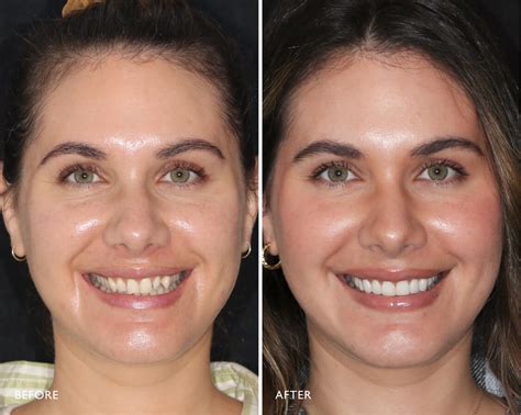 Before And After Veneers