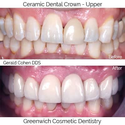 Dentist Greenwich CT | All Ceramic Dental Crowns