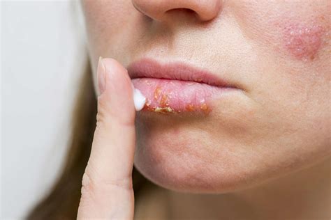 Swelling Lips Allergic Reaction Treatment | Lipstutorial.org