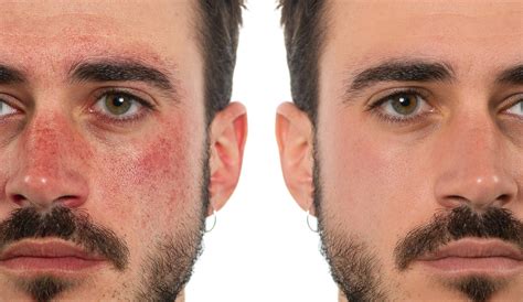 NON-COMEDOGENIC COSMETICS