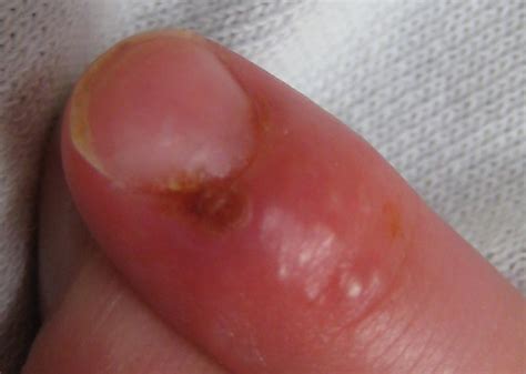 Herpetic whitlow: Symptoms, causes, and treatment