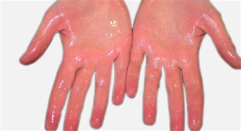 hyperhidrosis hands