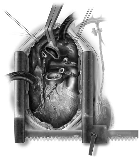 Reoperative Repair of Aortic Root and Ascending Aorta - Operative