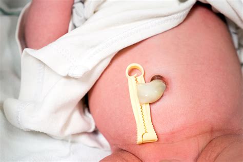 Umbigo Normal De Bebe - Cuidados com o umbigo do recém nascido - Meu Mundo Mudou - Gestação ...