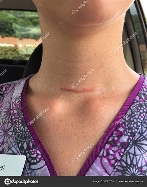Scar Tissue After Thyroid Surgery