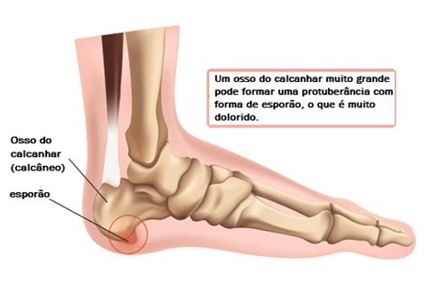 O Que Significa Dor No Calcanhar - Dor no calcanhar? Por que isso ocorre? - Melhor Com Saúde