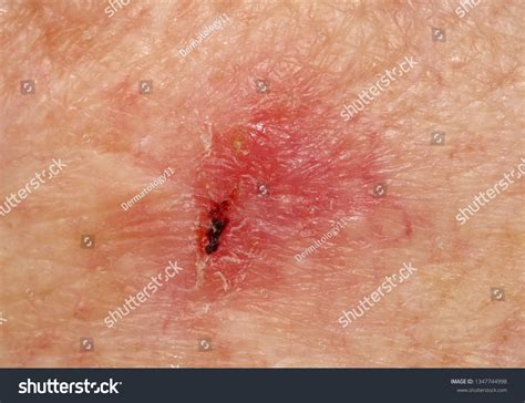 Case Ulcerated Superficial Basal Cell Carcinoma Stock Photo 1347744998 ...