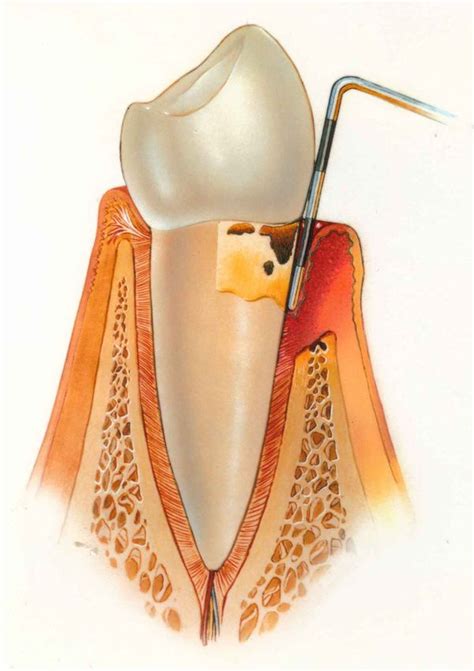 Gum Disease, Rheumatoid/Osteo-arthritis, Fibromyalgia & Autoimmune ...