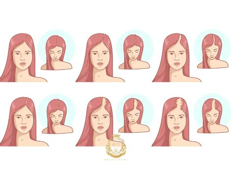 Hair Loss in Women | Hair Transplant Turkey