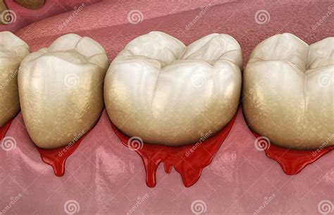 bleeding gums  periodontal pathological inflammatory condition