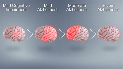 progression  alzheimers disease   stages