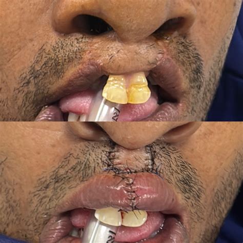 Lip Reduction Surgery – Richardson's Plastic Surgery Hospitals