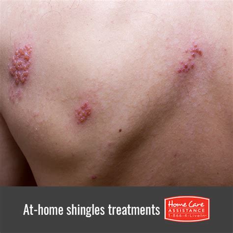 5 Ways to Treat Your Senior Loved One’s Shingles