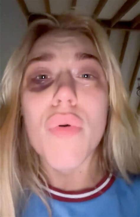 Elle Brooke in floods of tears with sickening black eye after Man City