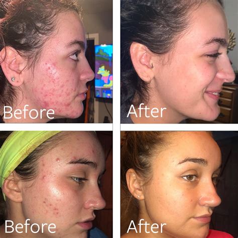 how to get rid of body acne 5