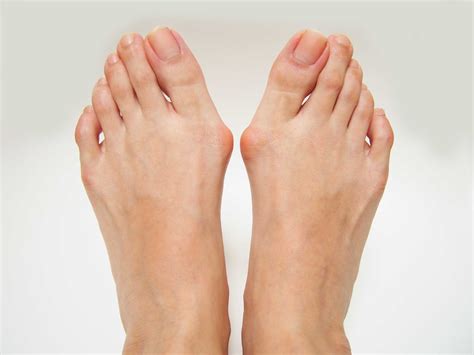 Bunion - Edmonton Foot Health Centre
