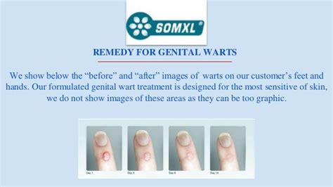 Genital Wart Remedy | Wartcream