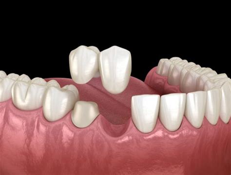 Cantilever Dental Bridges | Comprehensive Guide