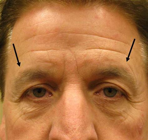 Blefaroplastia o corrección de ptosis de la ceja, ¿Qué necesito? - Qvision