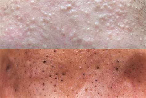 Unbelievable Blackhead Removal 2024: Say Goodbye to Pores! - 5coel1d