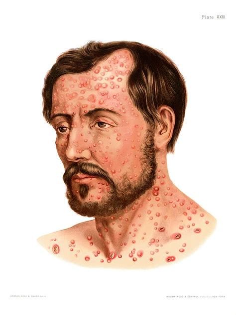 secondary syphilis rash   science photo library