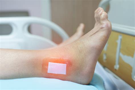 Surgical Wound Recovery - United Wound Care Centers