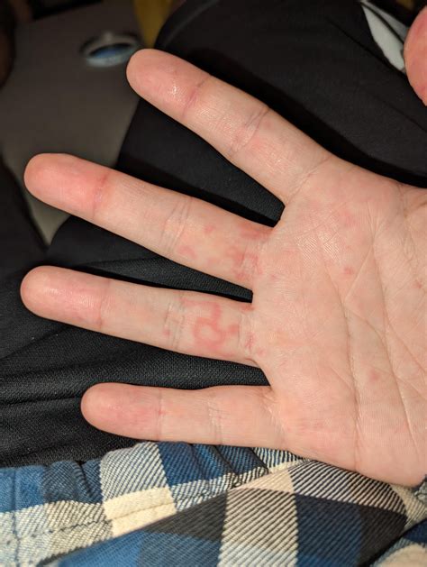 I have this rash on both hands. day 1, day 2, and day 3. my Dr thought