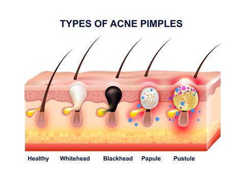 Skin Acne Anatomy Composition 482327 Vector Art at Vecteezy