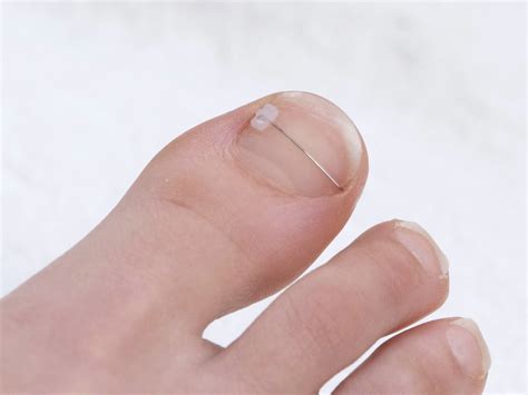 Orthonyxie - Nagelspangen - Hilfe bei eingewachsenem Nagel - PODO-LOGIK ...