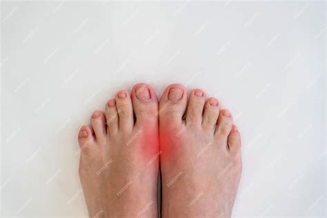 Premium Photo | Feet disease rheumatism and gout painful gout ...