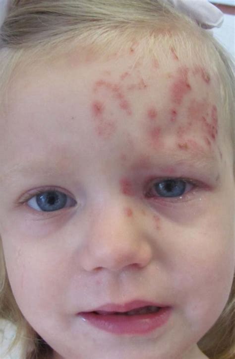 herpes zoster ophthalmicus    healthy  year  child