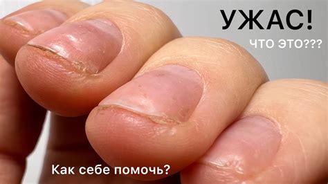 Поврежденные ногти. Что делать? Можно ли покрывать гель-лаком?Как ...