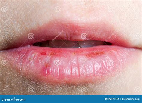 fix dry cracking lips  crystal molden blog