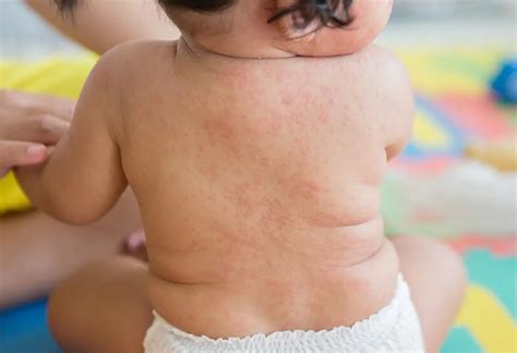 Viral Rash in Infants: Types, Diagnosis & Treatment