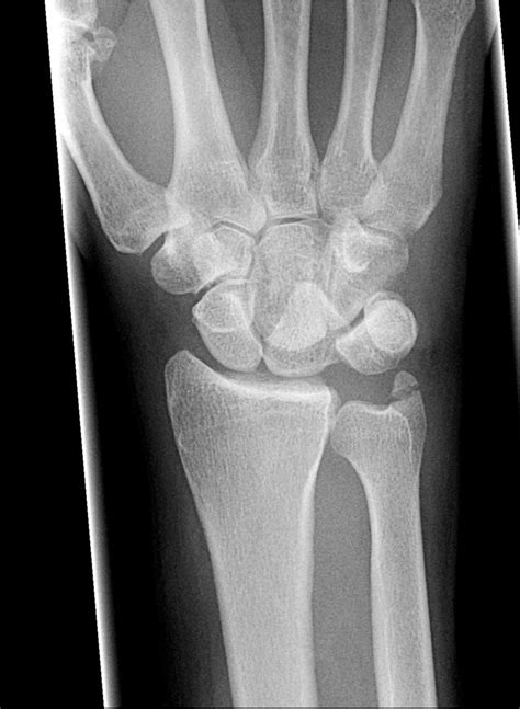 Normal wrist xray - rytego