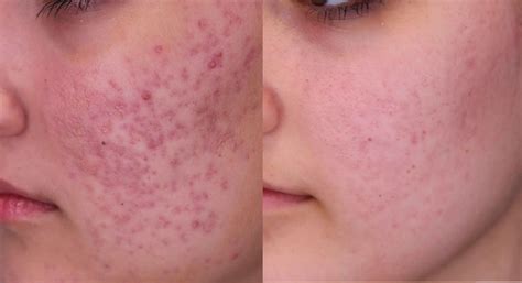 scar removal treatment  australia cutis dermatology