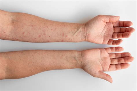 Bolinhas No Braço O Que Pode Ser - Bolinhas no braço: Dr. explica o que pode ser e como tratar