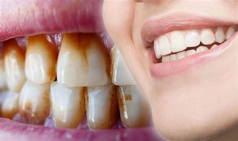 Remove Coffee Stains From Between Teeth / Tips To Help Avoid Stained ...