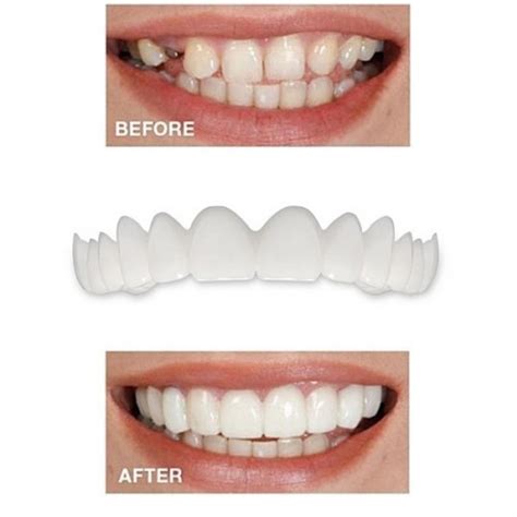 Купить Виниры на зубы Snapon Smile оптом, цена оптом от 60 рублей ...