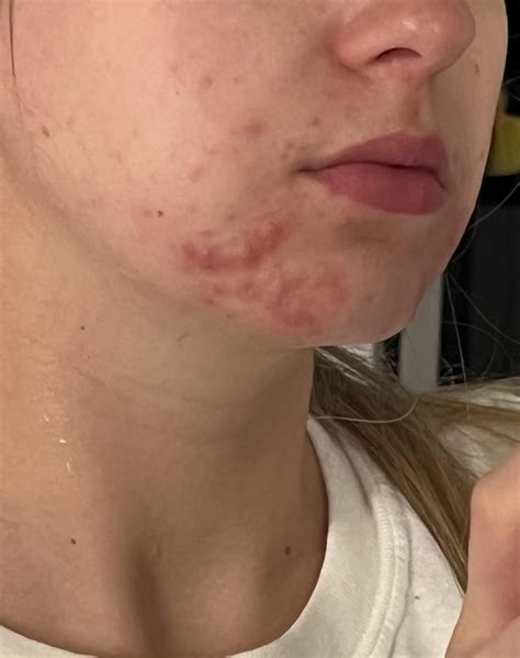 Nexplanon acne : r/Nexplanon