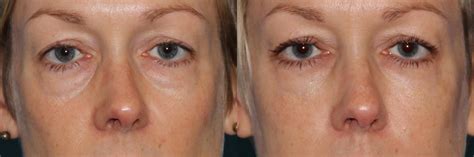 The Eyes Have It: Eye Rejuvenation With BOTOX® & Fillers (Before and ...