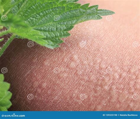 Stinging Nettle Lying On Irritated Human Skin Covered With Small Wrinkles ,cracks And Causes A ...