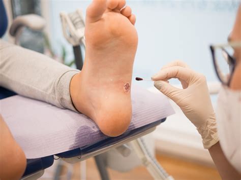 Plantar Wart Arch Of Foot at Ian Stewart blog
