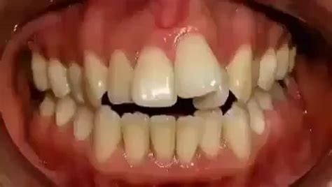 Gingivitis gum disease wobbly teeth – Artofit