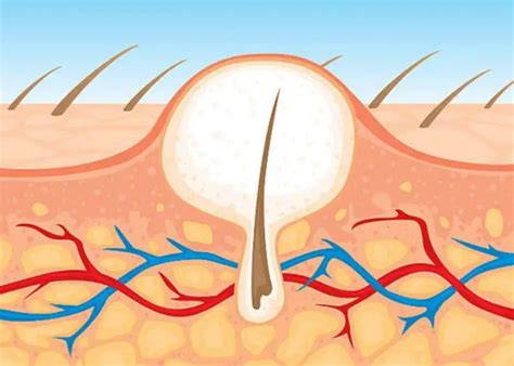 how to heal ingrown hair bump