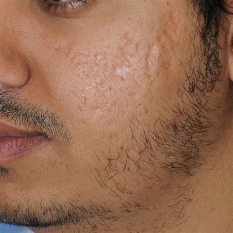 Severe Cystic Acne Scars