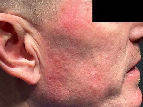 Procedures--Sclerotherapy-:-Leg & Facial Veins — CPW Vein and Aesthetic